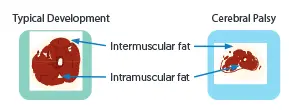Increased intermuscular and intramuscular adipose tissue