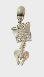 Pelvic obliquity and scoliosis skeletal diagram